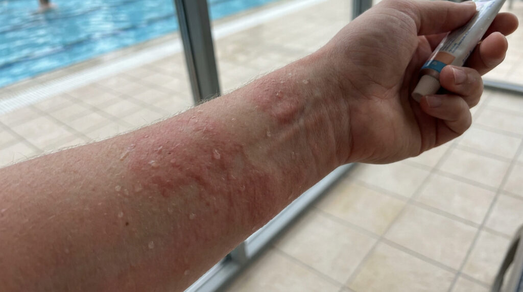 Avant-bras présentant une plaque rouge et irritée suite à une exposition au chlore d'une piscine.